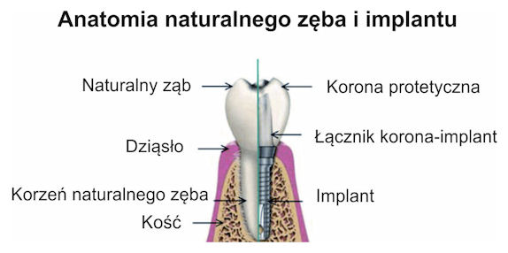 Anatomia zęba naturalnego i implantu