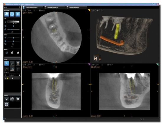 Implanty - obrazowanie 3D